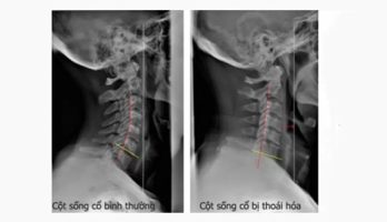Hình ảnh X quang thoái hóa cột sống theo từng vị trí và Chẩn đoán